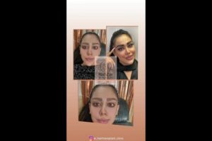 -بعد-از-کاشت-ابرو-poster