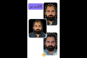 -و-بعد-کاشت-مو-poster