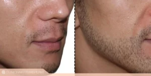 قبل و بعد کاشت ریش