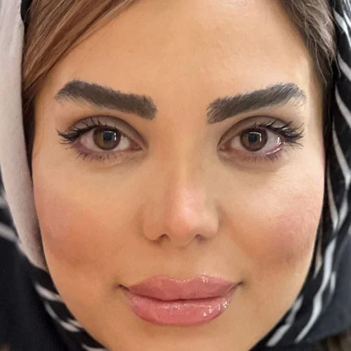 بعد از کاشت ابرو