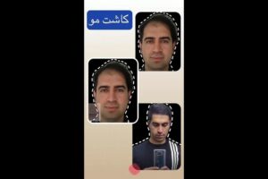 -مو-قبل-و-بعد-کلینیک-ماه-زر-poster