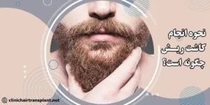 کاشت ریش به چه صورت است