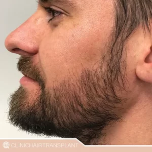 کاشت ریش در چه سنی انجام می_شود؟