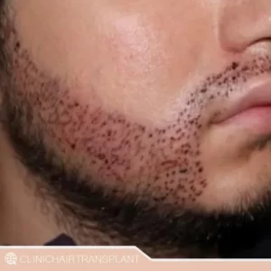 کاشت ریش چگونه انجام میشود؟