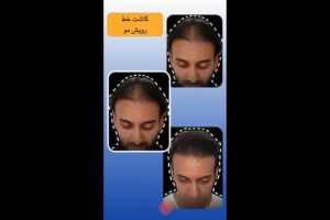 کاشت-موی-سر-قبل-و-بعد-poster