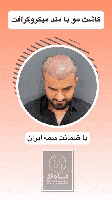 کاشت مو بعد از ۳ ماه