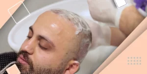 طریقه حمام بعد از کاشت مو