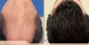 نتیجه قبل و بعد کاشت مو