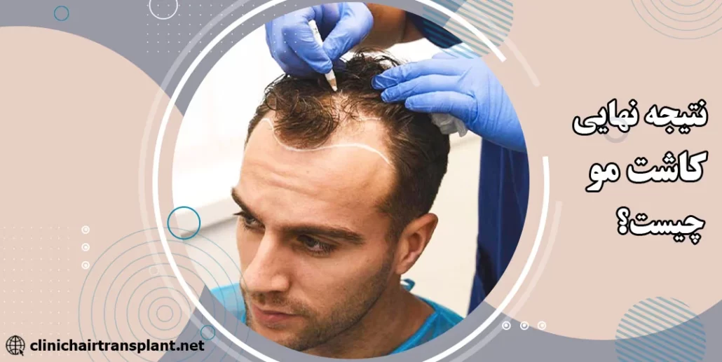 نتیجه نهایی بعد از کاشت مو چیست؟