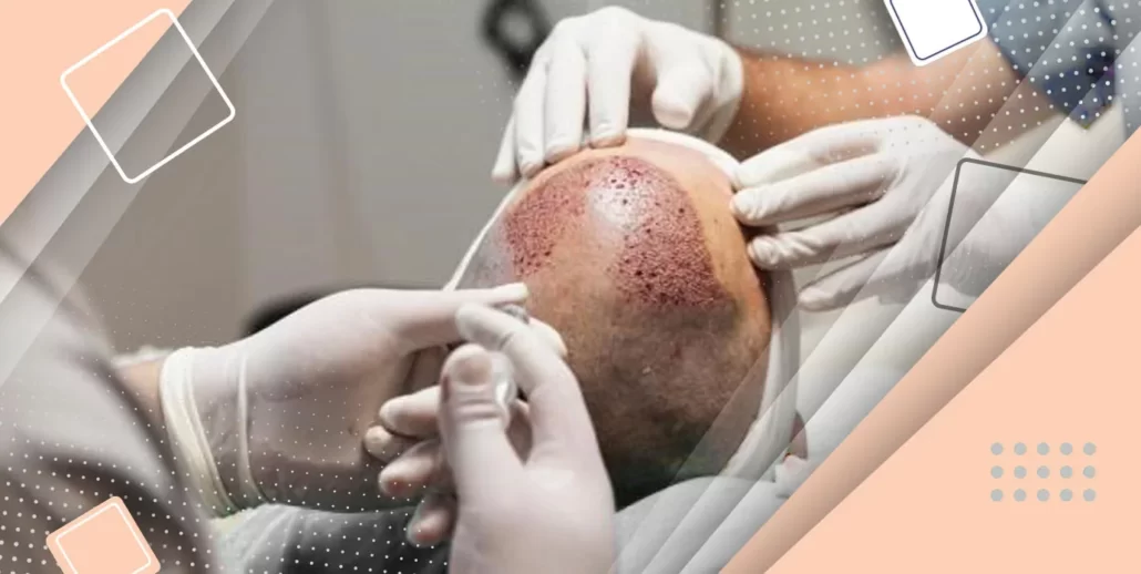 انتقال و قرار دادن فولیکولها در ناحیه کاشت-مزایا کاشت مو به روش sut