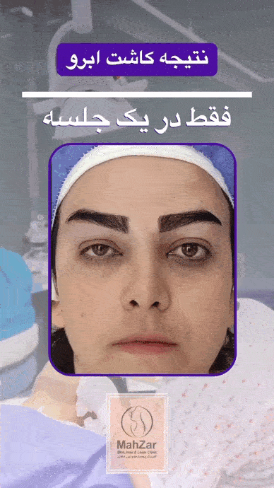 بوتاکس بعد از کاشت ابرو