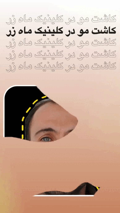 حمام بعد از کاشت مو