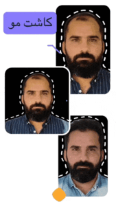 نتیجه کاشت مو به روش RHT