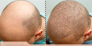 قبل و بعد کاشت مو در دوران نقاهت
