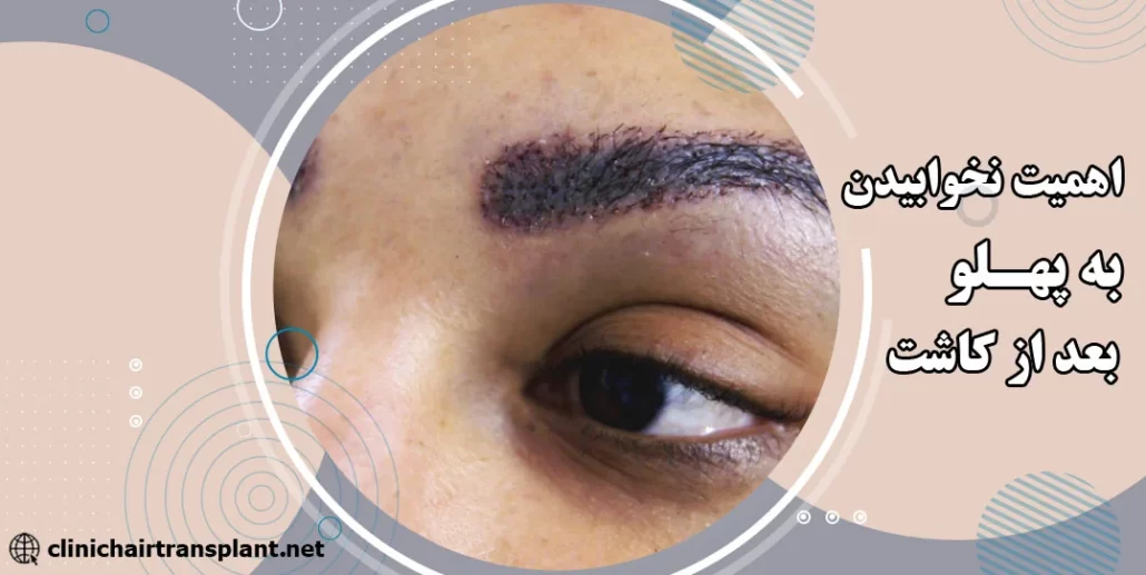 چرا بعد از کاشت ابرو نباید به پهلو خوابید؟