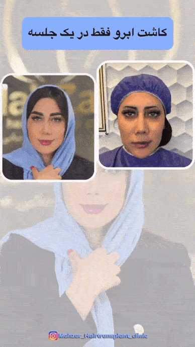 ماینوکسیدیل برای ابرو
