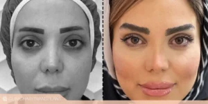 نشسته خوابیدن بعد کاشت ابرو