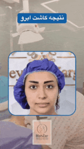 خارش ابرو بعد از کاشت