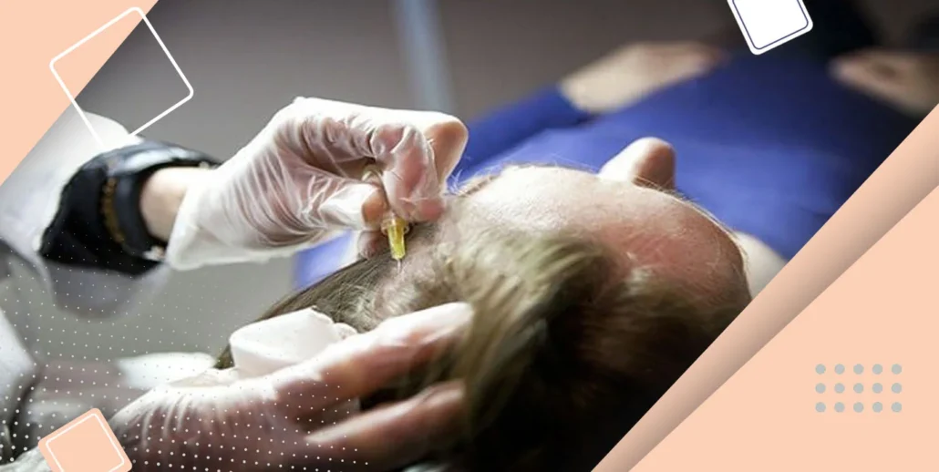 کربوکسی تراپی برای احیای مو