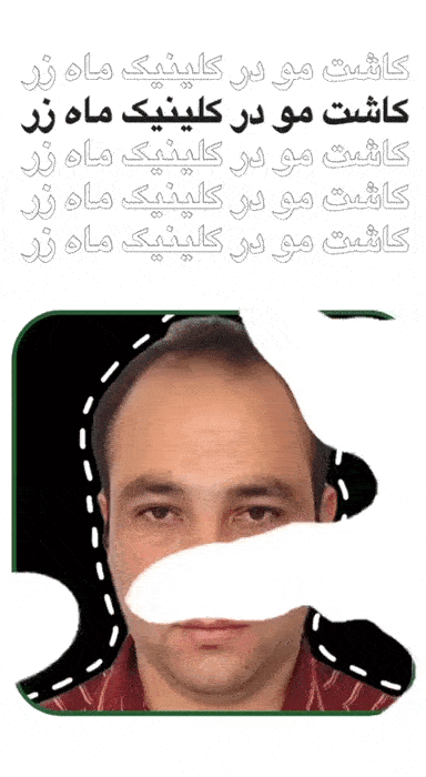 میزان رشد مو کاشته شده