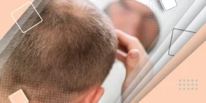 دلایل ترک و شیار سر پس از کاشت مو چیست؟