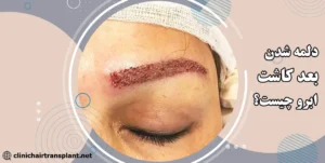 دلمه بعد از کاشت ابرو طبیعی