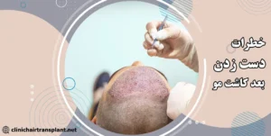 خطرات دست زدن به موهای کاشته شده