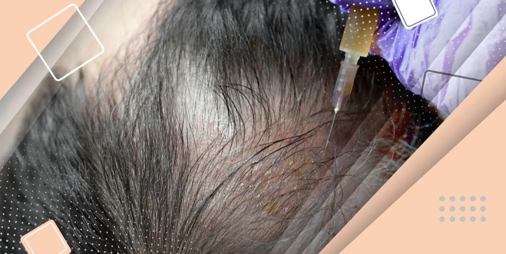 چه زمانی پس از پیوند PRP انجام دهیم؟