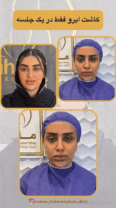 آیا کاشت ابرو نیاز به ترمیم دارد؟