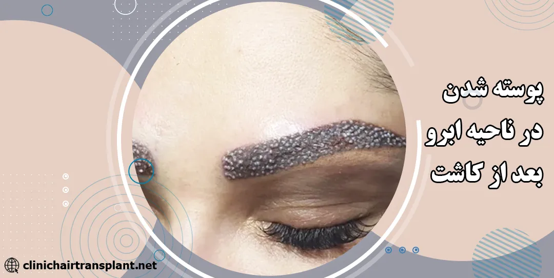 چه کسانی کاندید مناسب برای کاشت ابرو هستند