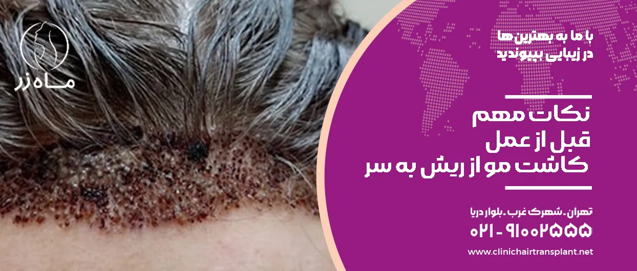 نکات مهم قبل از عمل کاشت مو از ریش به سر