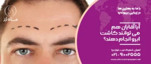 آیا آقایان هم می توانند کاشت ابرو انجام دهند؟