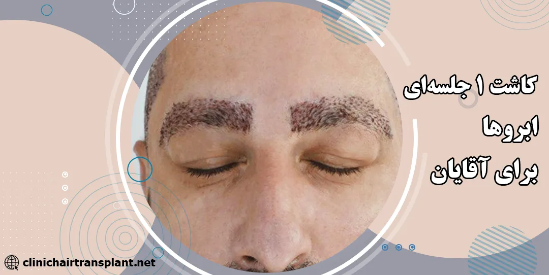 کاشت ابرو برای آقایان