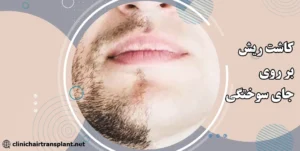 کاشت ریش جای سوختگی
