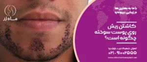 کاشتن ریش روی پوست سوخته چگونه است؟