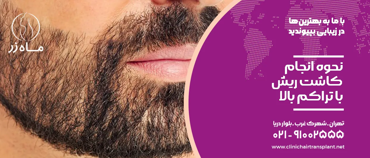نحوه انجام کاشت ریش با تراکم بالا