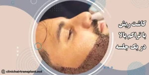 کاشت ریش با تراکم بالا