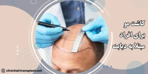 کاشت مو برای دیابتی‌ها