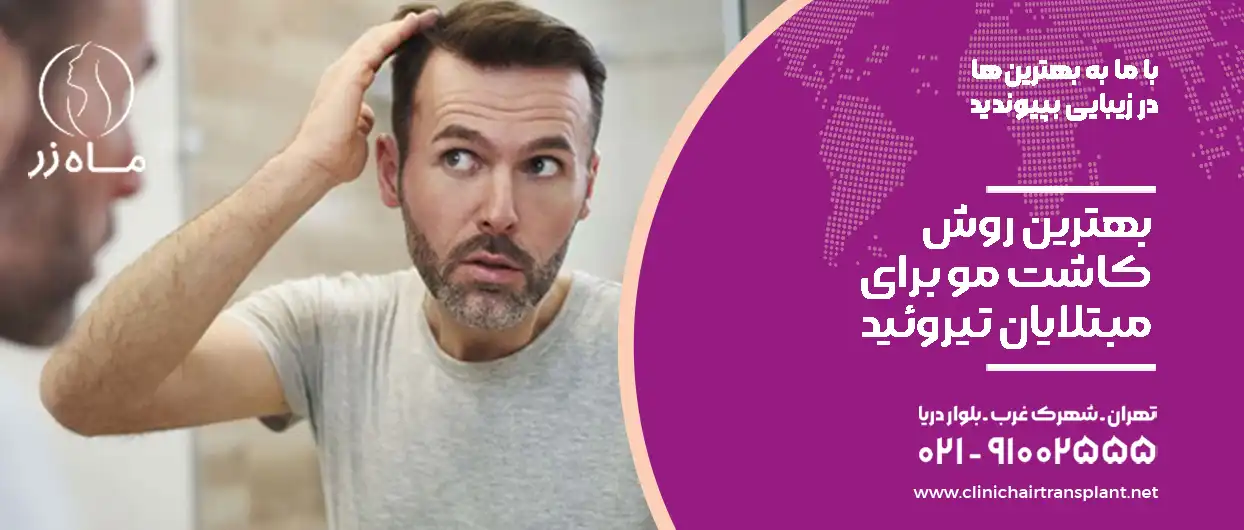 بهترین روش کاشت مو برای مبتلایان تیروئید