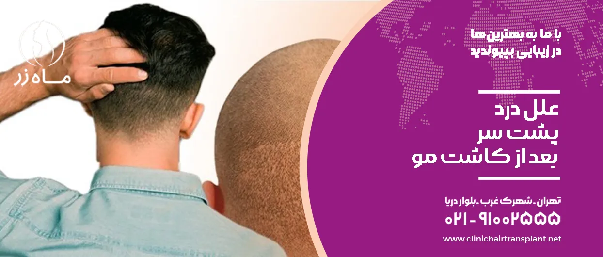 علل درد پشت سر بعد از کاشت مو