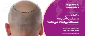 کاشت مو در سنین پایین چه مشکلاتی ایجاد می‌کند؟