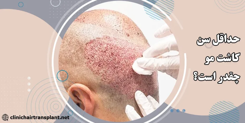 حداقل سن کاشت مو چقدر است؟
