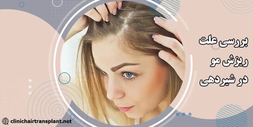 علت ریزش مو در شیردهی