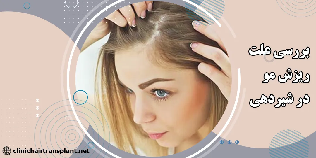 علت ریزش مو در شیردهی
