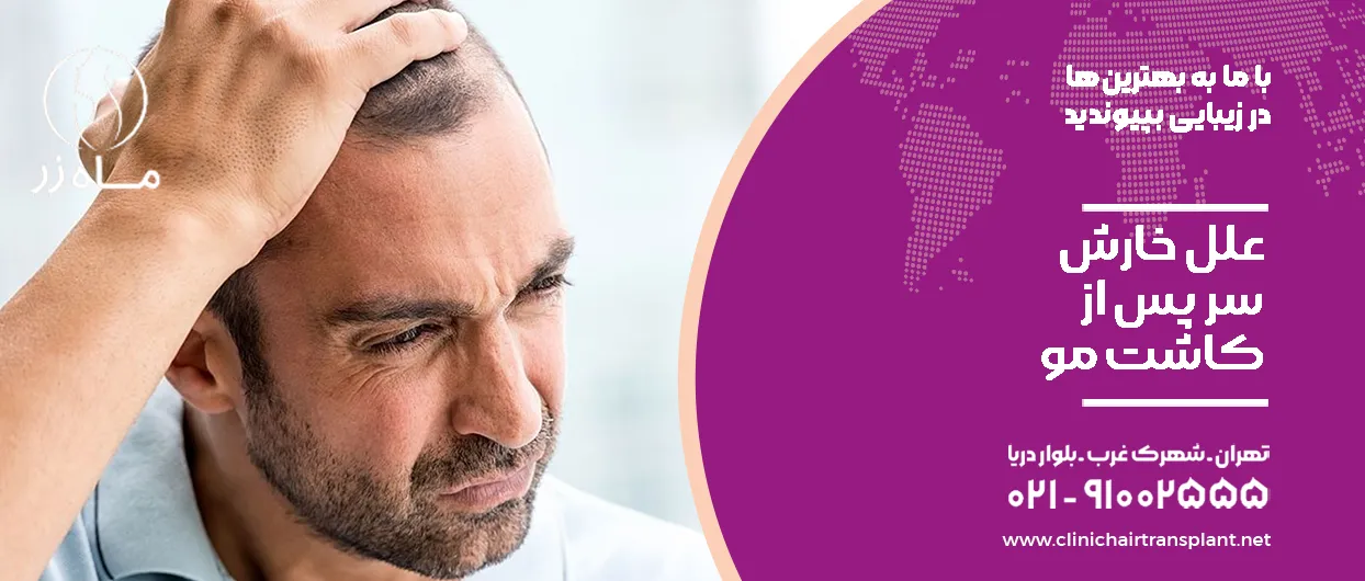 علل خارش سر پس از کاشت مو