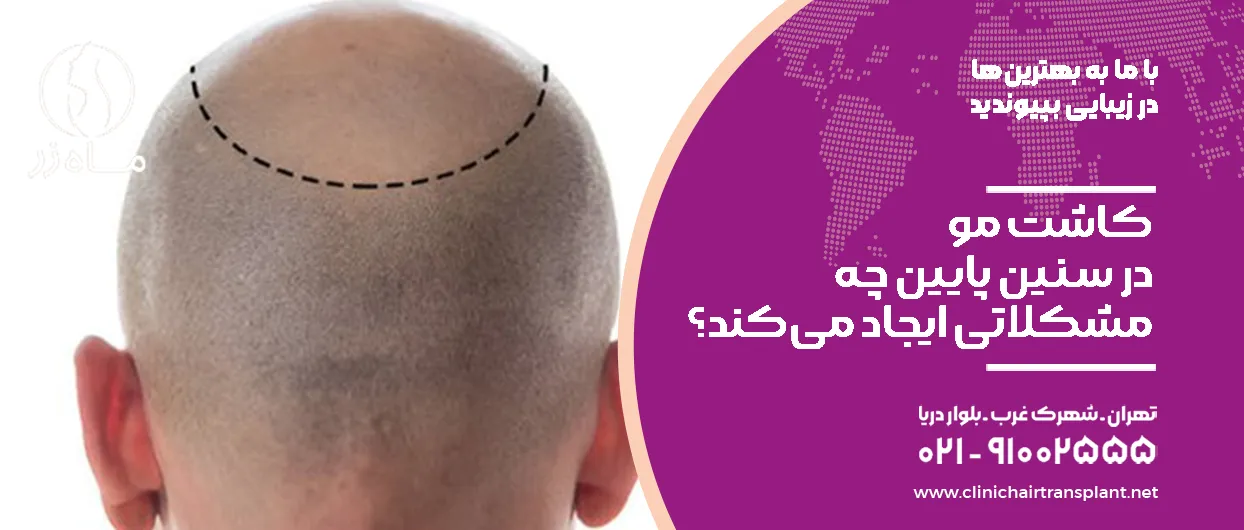 کاشت مو در سنین پایین چه مشکلاتی ایجاد می‌کند؟