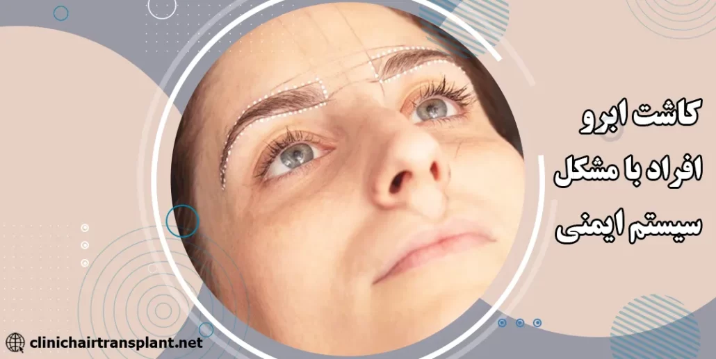 کاشت ابرو افراد با مشکلات سیستم ایمنی