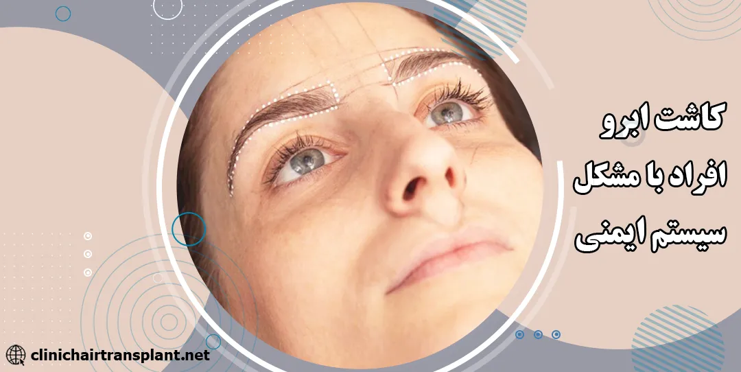 کاشت ابرو افراد با مشکلات سیستم ایمنی