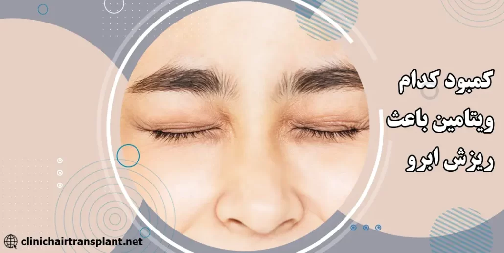 کمبود کدام ویتامین باعث ریزش ابرو میشود؟