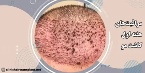 مراقبت‌های بعد از کاشت مو در هفته اول